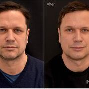 Vitalraum Lörrach Infuzion System, weniger Falten in 20 Minuten, Anti-Aging, Faltenreduktion, Hautverjüngung, Schönheitsoperation, Falten ade, jugendliche Haut, jugendliche Ausstrahlung, Hyaluron, Hyaluronaufbau, Hyaluronunterspritzung, Hyaluronbehandlung, ohne Schmerzen, Gesichtsbehandlung, Kosmetikbehandlung, Faltenbehandlung, Anti-Faltenbehandlung, 