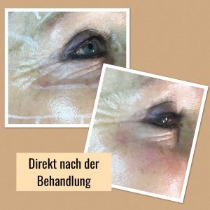 Facelift ohne OP