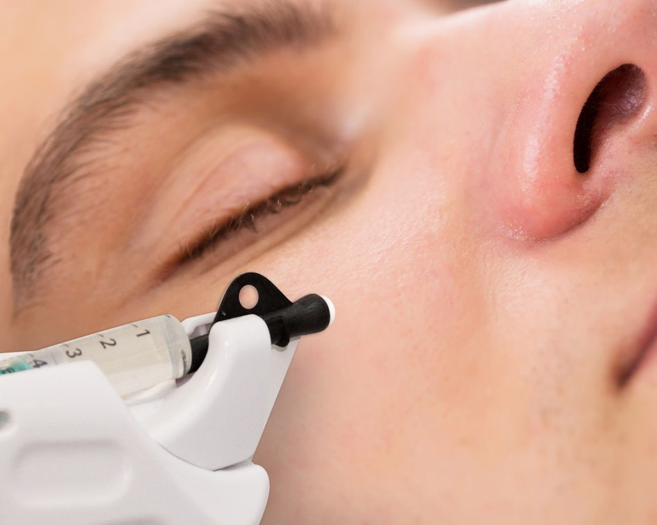 Vitalraum Lörrach Infuzion System, weniger Falten in 20 Minuten, Anti-Aging, Faltenreduktion, Hautverjüngung, Schönheitsoperation, Falten ade, jugendliche Haut, jugendliche Ausstrahlung, Hyaluron, Hyaluronaufbau, Hyaluronunterspritzung, Hyaluronbehandlung, ohne Schmerzen, Gesichtsbehandlung, Kosmetikbehandlung, Faltenbehandlung, Anti-Faltenbehandlung, 