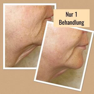 Facelift ohne OP