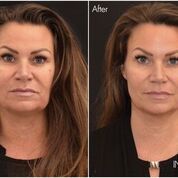 Vitalraum Lörrach Infuzion System, weniger Falten in 20 Minuten, Anti-Aging, Faltenreduktion, Hautverjüngung, Schönheitsoperation, Falten ade, jugendliche Haut, jugendliche Ausstrahlung, Hyaluron, Hyaluronaufbau, Hyaluronunterspritzung, Hyaluronbehandlung, ohne Schmerzen, Gesichtsbehandlung, Kosmetikbehandlung, Faltenbehandlung, Anti-Faltenbehandlung, 