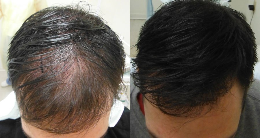 Kopfhautpigmentirung, Haarbodenverdichtung, Skalppigmentation, scalp micropigmentation