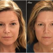 Vitalraum Lörrach Infuzion System, weniger Falten in 20 Minuten, Anti-Aging, Faltenreduktion, Hautverjüngung, Schönheitsoperation, Falten ade, jugendliche Haut, jugendliche Ausstrahlung, Hyaluron, Hyaluronaufbau, Hyaluronunterspritzung, Hyaluronbehandlung, ohne Schmerzen, Gesichtsbehandlung, Kosmetikbehandlung, Faltenbehandlung, Anti-Faltenbehandlung, 